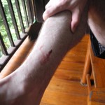 A leech bite is harmless but bleeds for a long time.